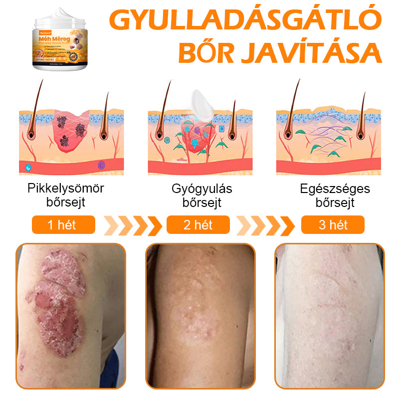 đăHivatalos MĂĄrkaboltăBĆRERĆâą MĂ©h MĂ©reg Psoriasis KezelĆ KrĂ©mïŒâPikkelysömörâSzemölcsâKörömgombaâïŒïŒ