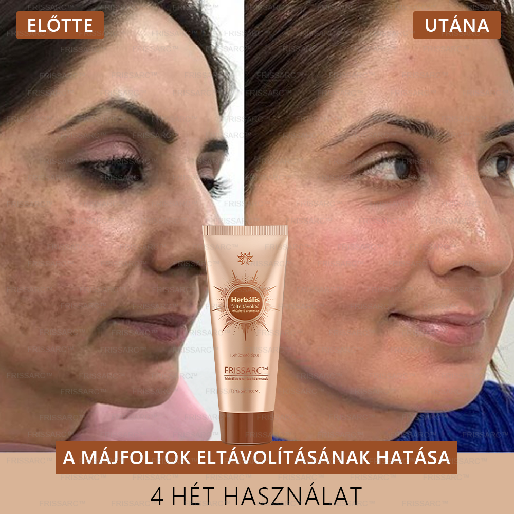 đđ FRISSARCâą fehĂ©rĂtĆ Ă©s folteltĂĄvolĂtĂł arcmaszk