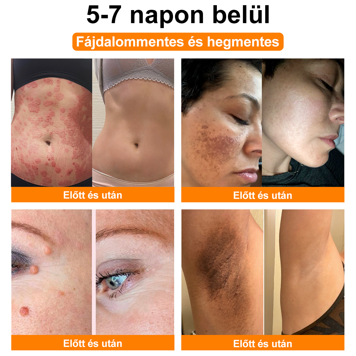 ⚜️⚜️⚜️【Hivatalos Márkabolt】BŐRERŐ™ Méh Méreg Psoriasis Kezelő Krém(⭐Pikkelysömör⭐Szemölcs⭐Körömgomba⭐)
