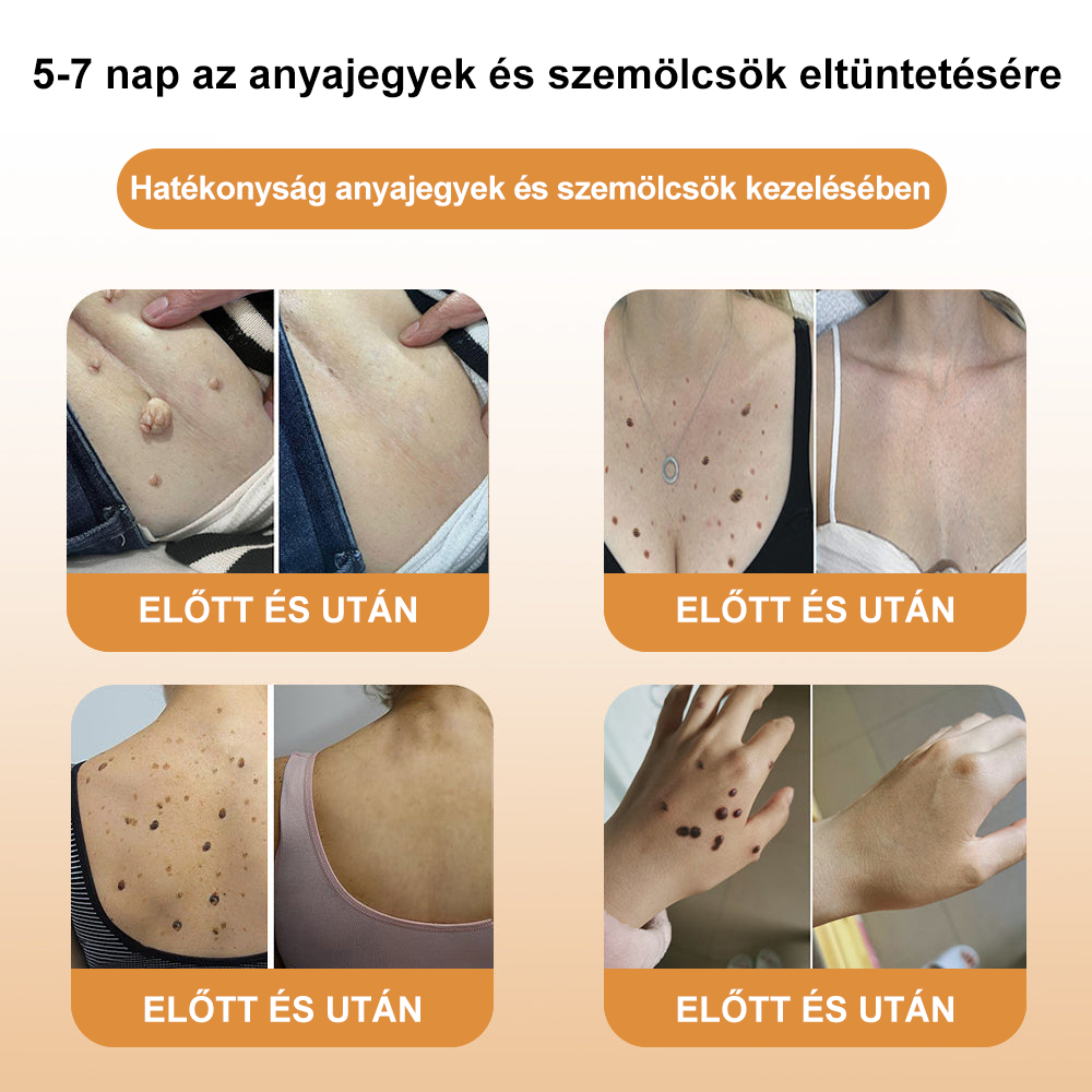 đđ GratulĂĄlunk, hogy az elsĆ 200 rendelĂ©s egyike lettĂ©l! Ălvezd az extra 50% kedvezmĂ©nyt! Cselekedj most, Ă©s Ćrizd meg bĆröd egĂ©szsĂ©gĂ©t. Ha most lemaradsz, csak jövĆre lesz Ășjabb lehetĆsĂ©g!