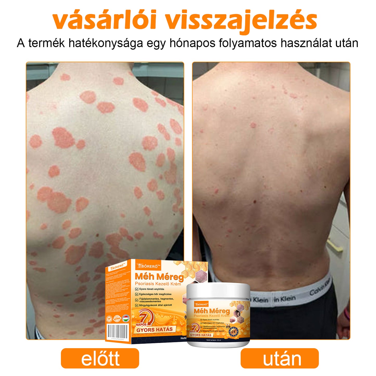 đăHivatalos MĂĄrkaboltăBĆRERĆâą MĂ©h MĂ©reg Psoriasis KezelĆ KrĂ©mïŒâPikkelysömörâSzemölcsâKörömgombaâïŒïŒ
