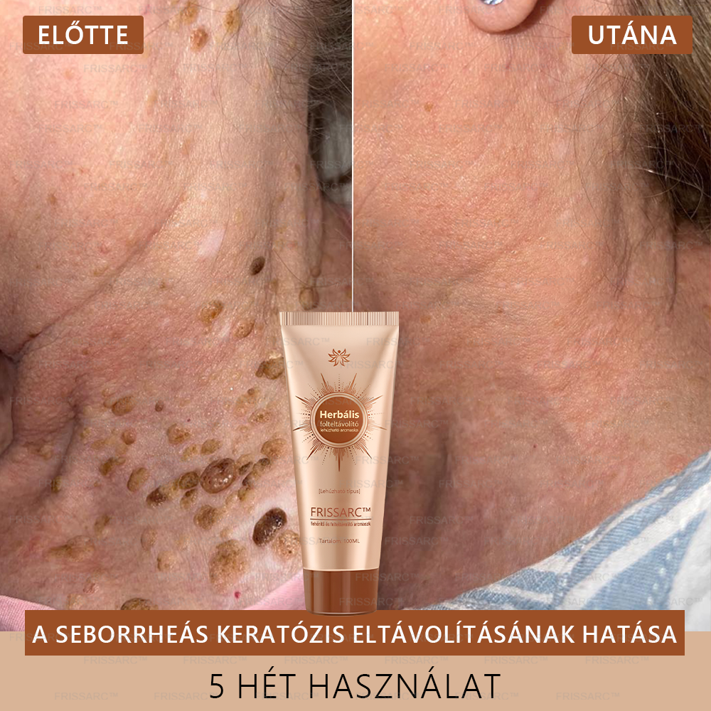 đđ FRISSARCâą fehĂ©rĂtĆ Ă©s folteltĂĄvolĂtĂł arcmaszk