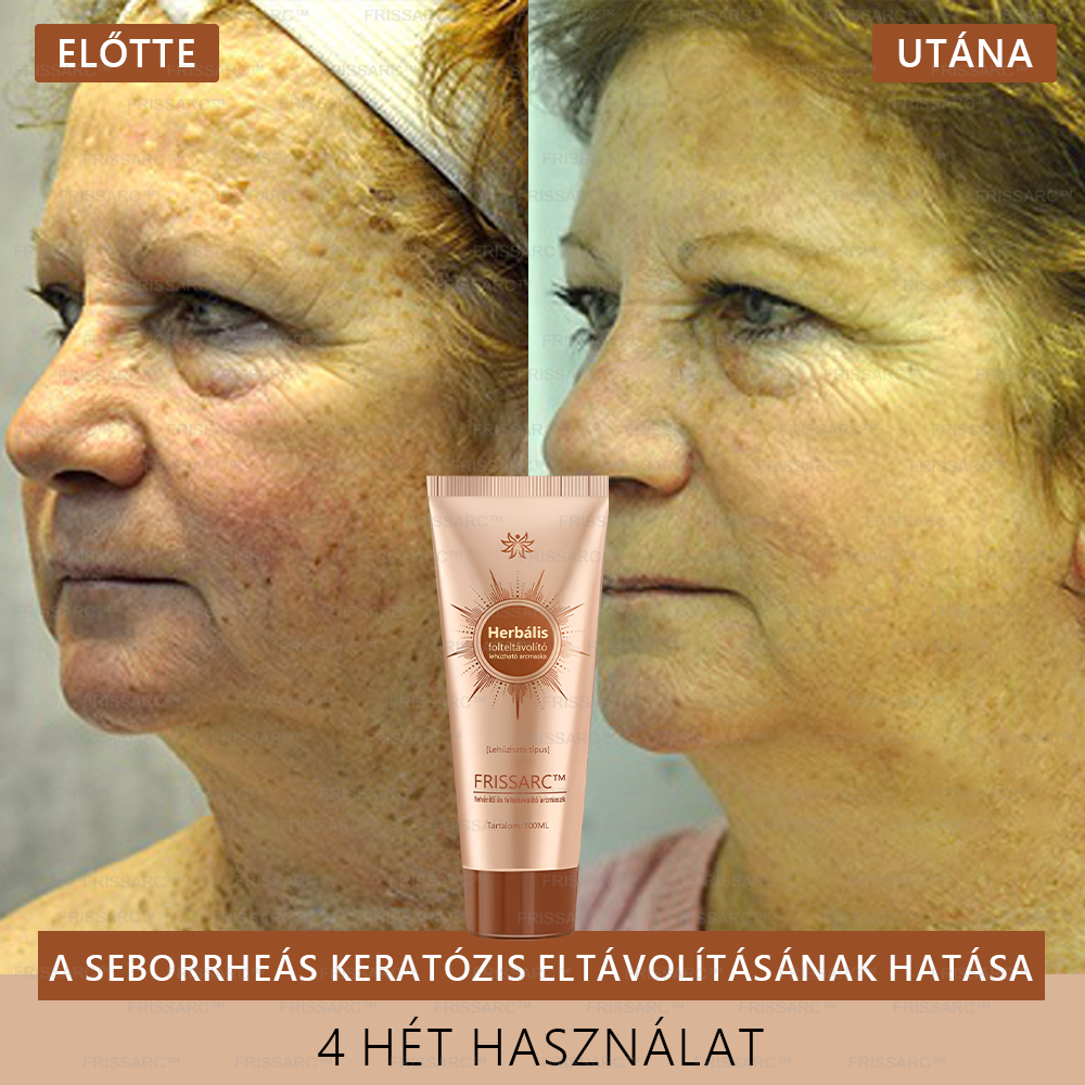 đđ FRISSARCâą fehĂ©rĂtĆ Ă©s folteltĂĄvolĂtĂł arcmaszk