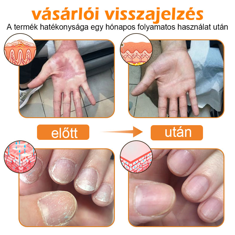 đăHivatalos MĂĄrkaboltăBĆRERĆâą MĂ©h MĂ©reg Psoriasis KezelĆ KrĂ©mïŒâPikkelysömörâSzemölcsâKörömgombaâïŒïŒ