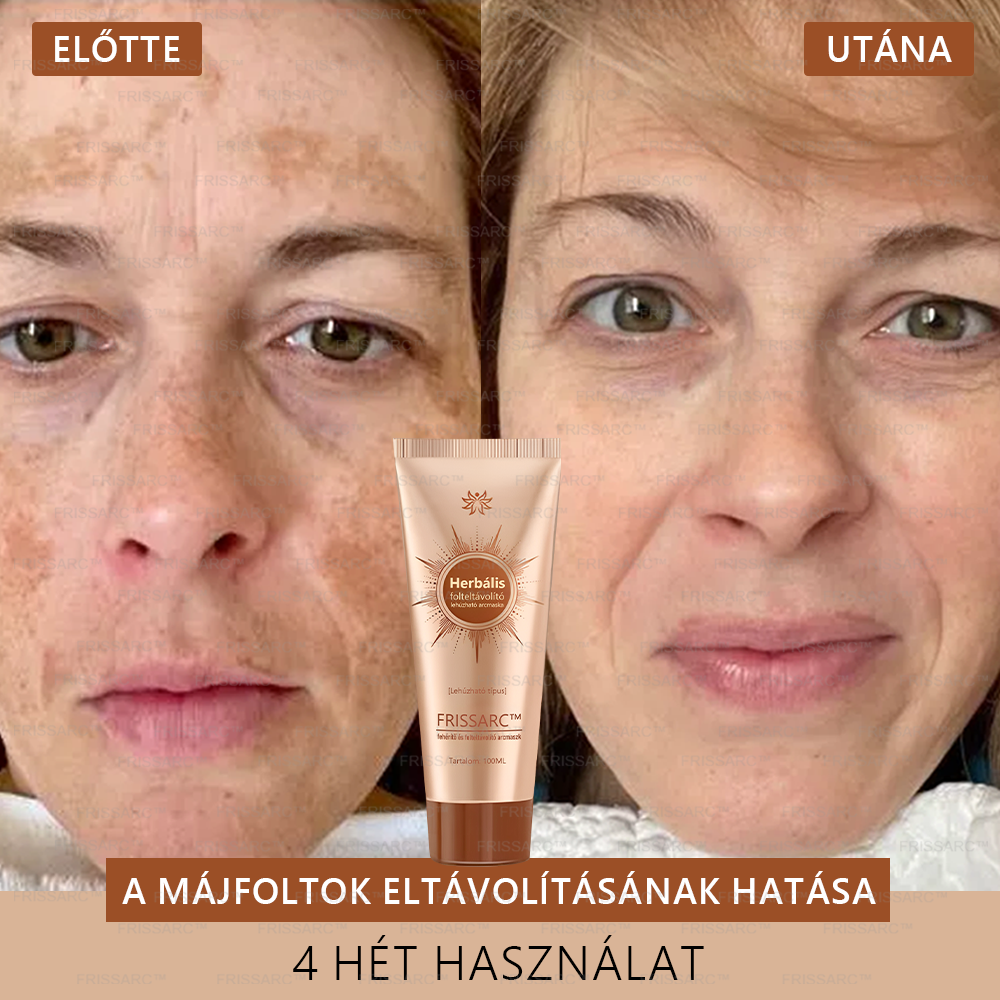 đđ FRISSARCâą fehĂ©rĂtĆ Ă©s folteltĂĄvolĂtĂł arcmaszk