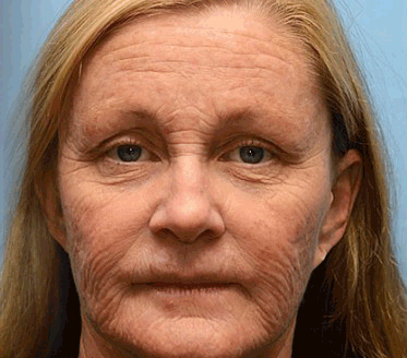 ⚜️⚜️⚜️【Hivatalos Márkabolt】FrissArc™ Botox Méhméreg Ránctalanító Krém