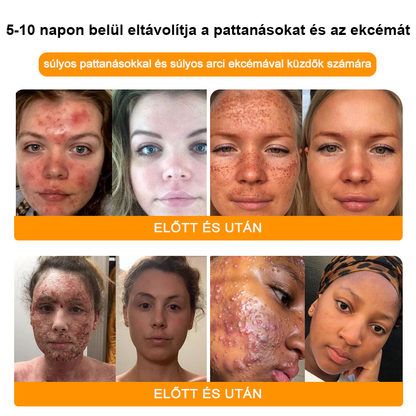 🌼GŐYUIŐ™ Szemölcs eltávolító és halványító krém🍯 4-6 héten belül teljesen eltávolítja a bőrcímkéket, szemölcsöket, pattanásokat és bőrpírt, klinikailag igazolt👩🏼‍⚕️ (Bőrgyógyászok erősen ajánlják)
