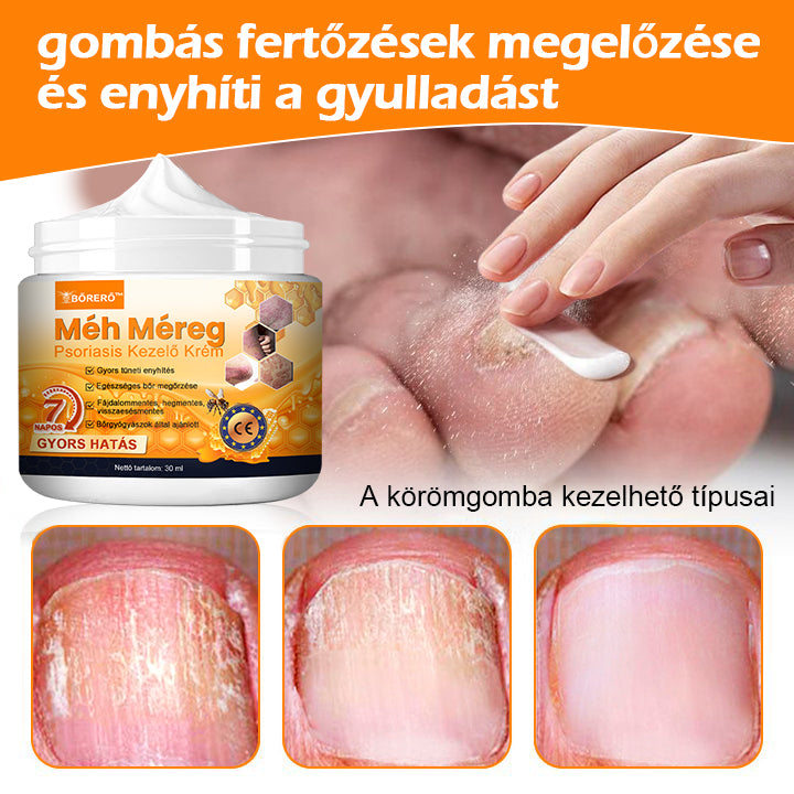 ⚜️⚜️⚜️【Hivatalos Márkabolt】BŐRERŐ™ Méh Méreg Psoriasis Kezelő Krém（⭐Pikkelysömör⭐Szemölcs⭐Körömgomba⭐）