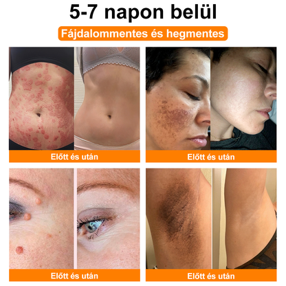 ⚜️⚜️⚜️【Hivatalos Márkabolt】BŐRERŐ™ Méh Méreg Psoriasis Kezelő Krém（⭐Pikkelysömör⭐Szemölcs⭐Körömgomba⭐）