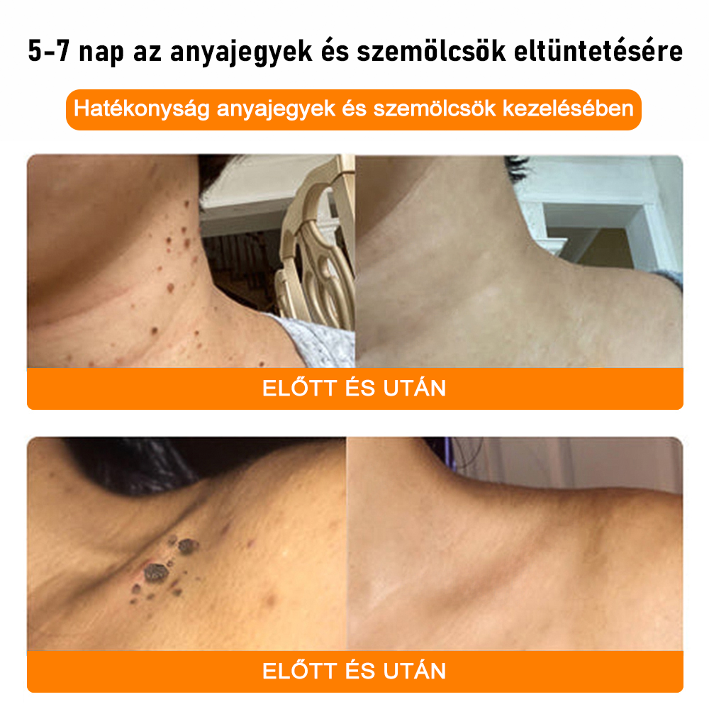 ⚜️⚜️⚜️【Hivatalos Márkabolt】BŐRERŐ™ Méh Méreg Psoriasis Kezelő Krém（⭐Pikkelysömör⭐Szemölcs⭐Körömgomba⭐）