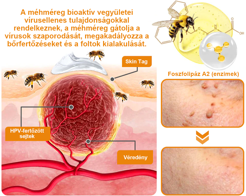 ⚜️⚜️⚜️【Hivatalos Márkabolt】BŐRERŐ™ Méh Méreg Psoriasis Kezelő Krém（⭐Pikkelysömör⭐Szemölcs⭐Körömgomba⭐）